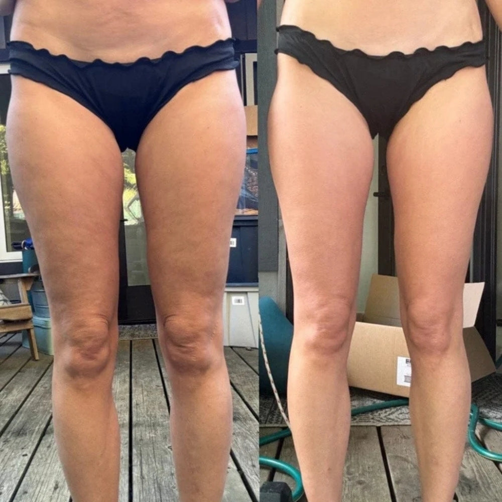 FINIBUY™ - Cellulite Massager